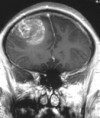 /album/neuroimagem/a617px-glioblastoma-mr-coronal-with-contrast-jpg/