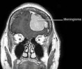 /album/neuroimagem/ans7-meningioma-jpg/