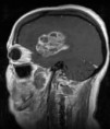 /album/neuroimagem/braintumor-jpg/