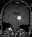 /album/neuroimagem/mribraintumorfront0020-jpg/