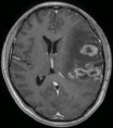 /album/neuroimagem/nhandq-brain-tumor-jpg/