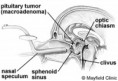 /album/diversas/pe-pituitarysurgery-figure1-jpg/