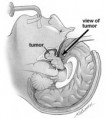 /album/diversas/pe-pituitarysurgery-figure3b-jpg/