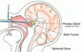 /album/diversas/transphenoidal-pituitary-surgery-gif/